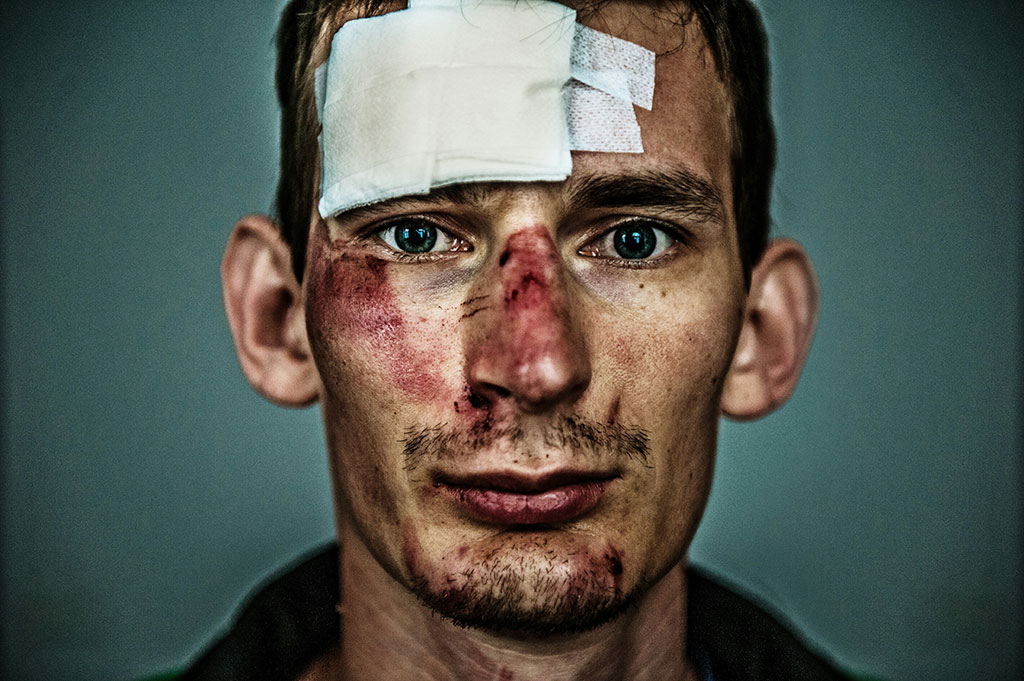 A close up of the face of a bruised and bloodied cyclist with a large bandage on his forehead.