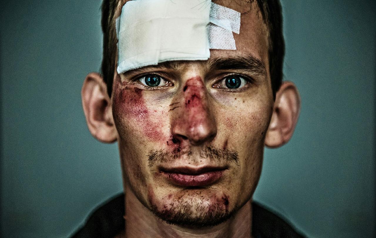 A close up of the face of a bruised and bloodied cyclist with a large bandage on his forehead.